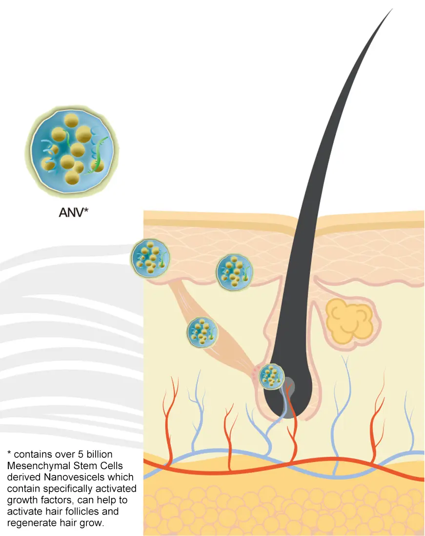 ANV Treatment Infographic